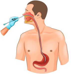 sonda nosowo-zoladkowa