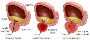 przerost prostaty