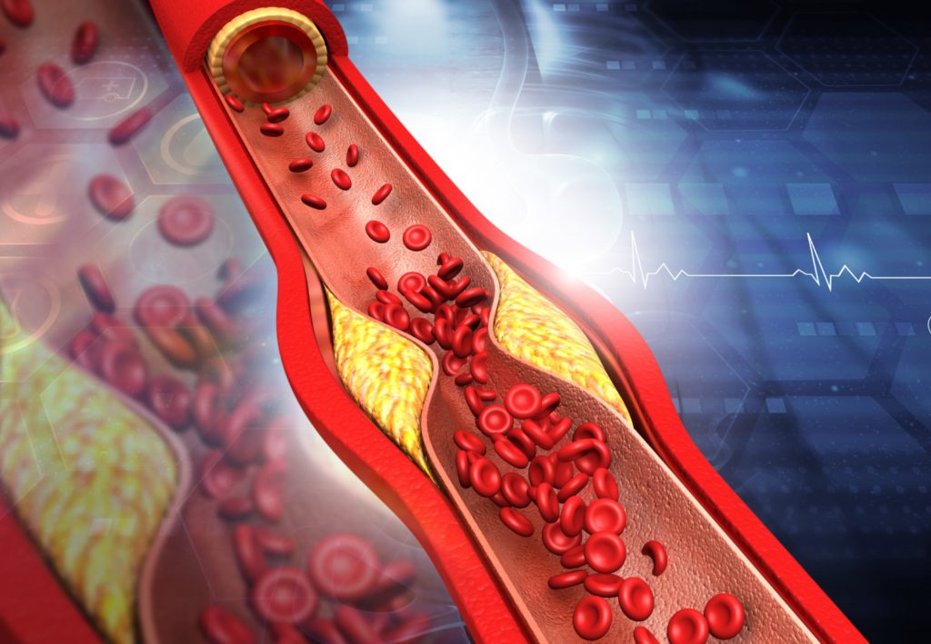 Hipercholesterolemia i miażdżyca